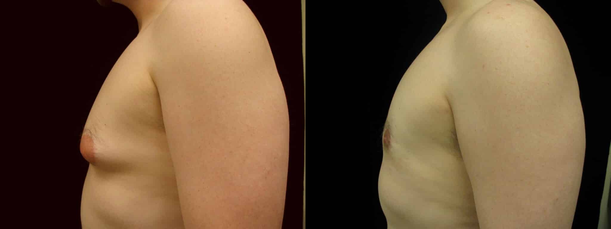 Gynecomastia Patient 7 Before & After Details