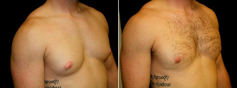 Gynecomastia Patient 13 Before & After Details