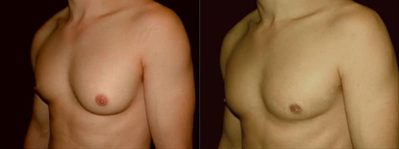 Gynecomastia Patient 1 Before & After Details