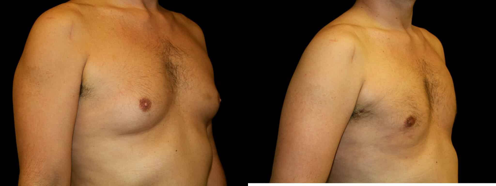 Gynecomastia Patient 14 Before & After Details