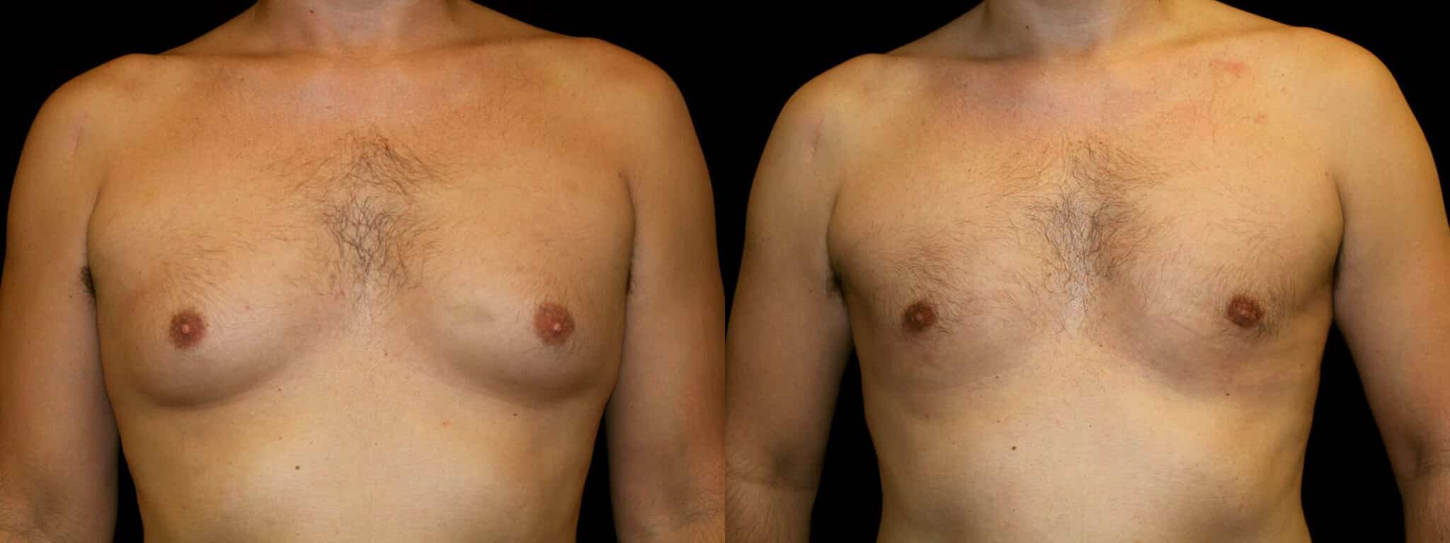 Gynecomastia Patient 14 Before & After