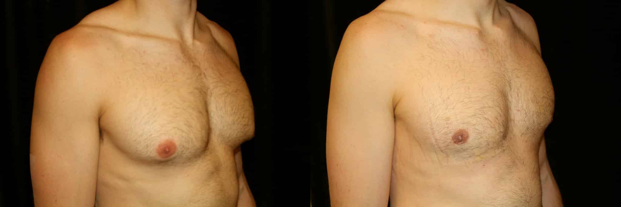 Gynecomastia Patient 10 Before & After Details