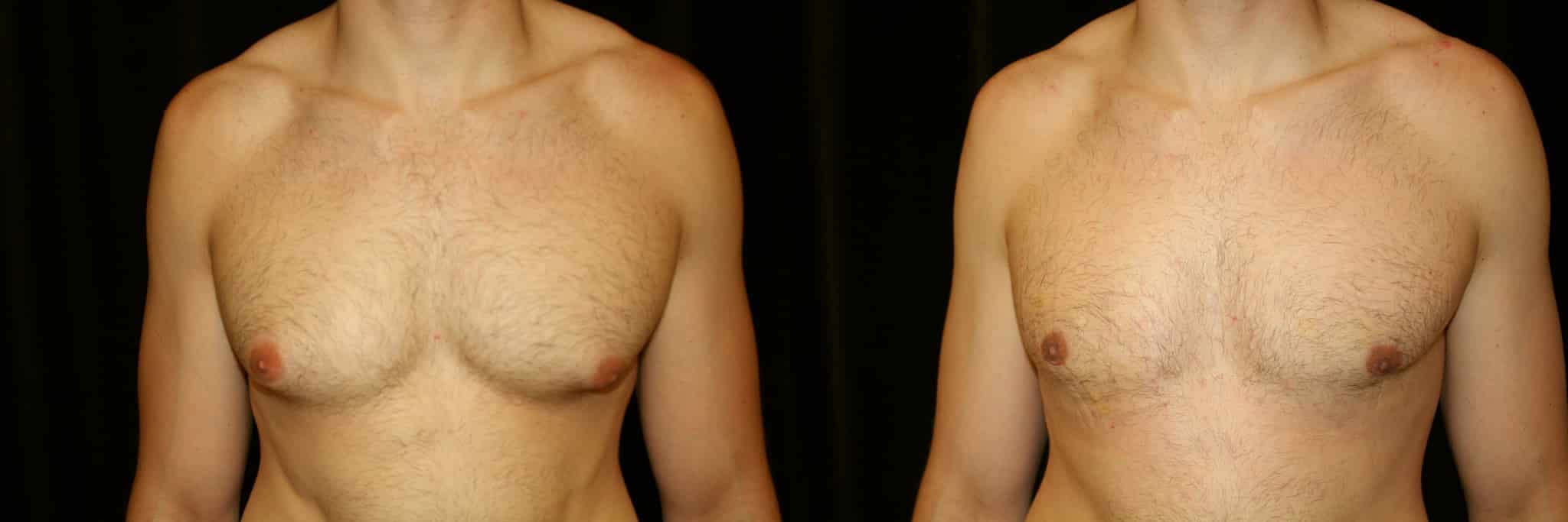Gynecomastia Patient 10 Before & After