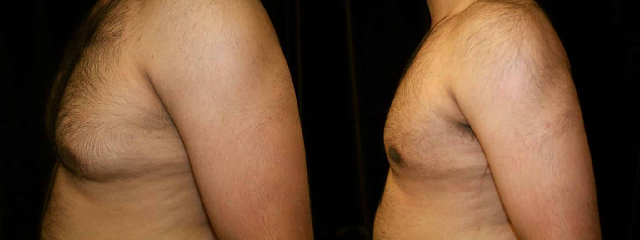 Gynecomastia Patient 2 Before & After Details