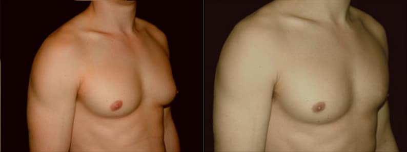 Gynecomastia Patient 1 Before & After Details