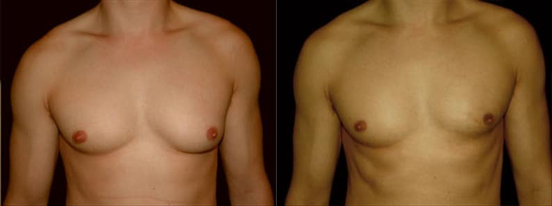 Gynecomastia Patient 1 Before & After