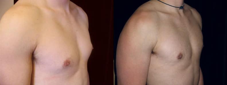 Gynecomastia Patient 5 Before & After Details