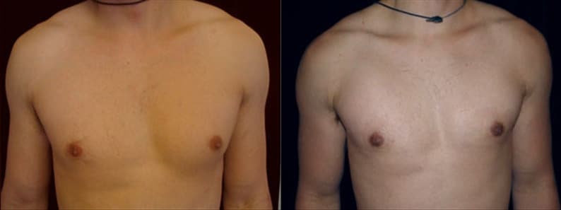 Gynecomastia Patient 5 Before & After