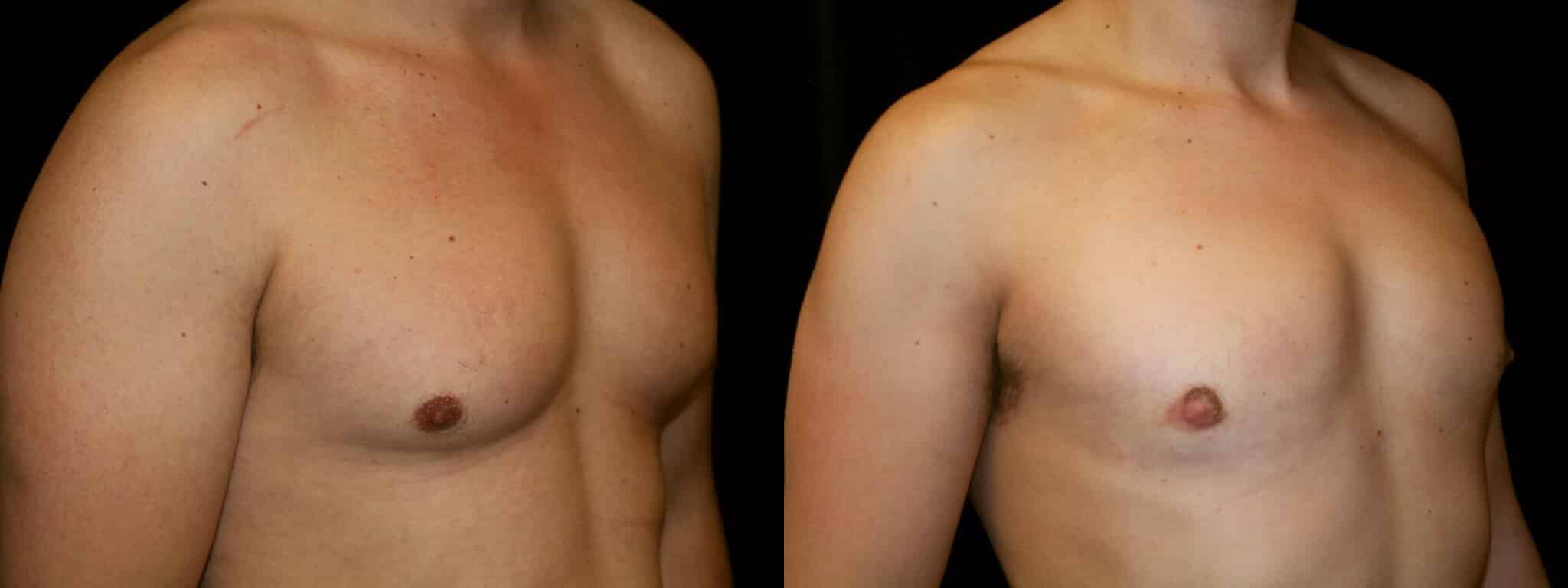 Gynecomastia Patient 1 Before & After Details