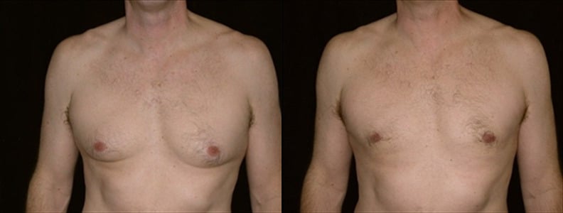 Gynecomastia Patient 12 Before & After