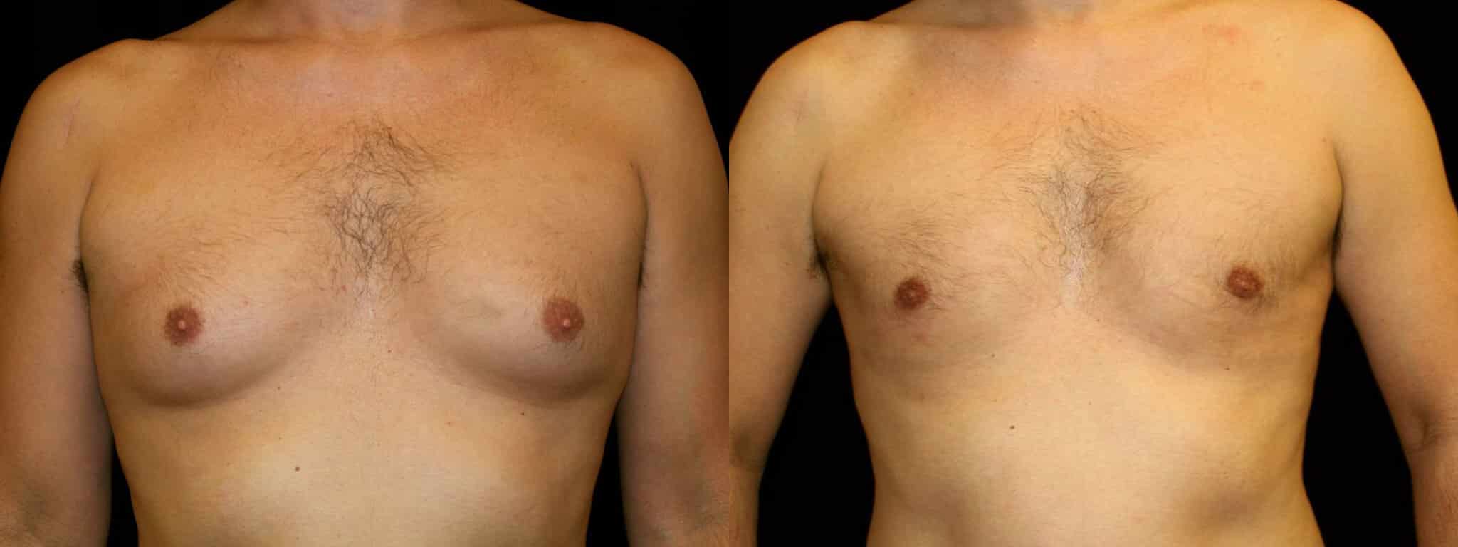 Gynecomastia Patient 21 Before & After