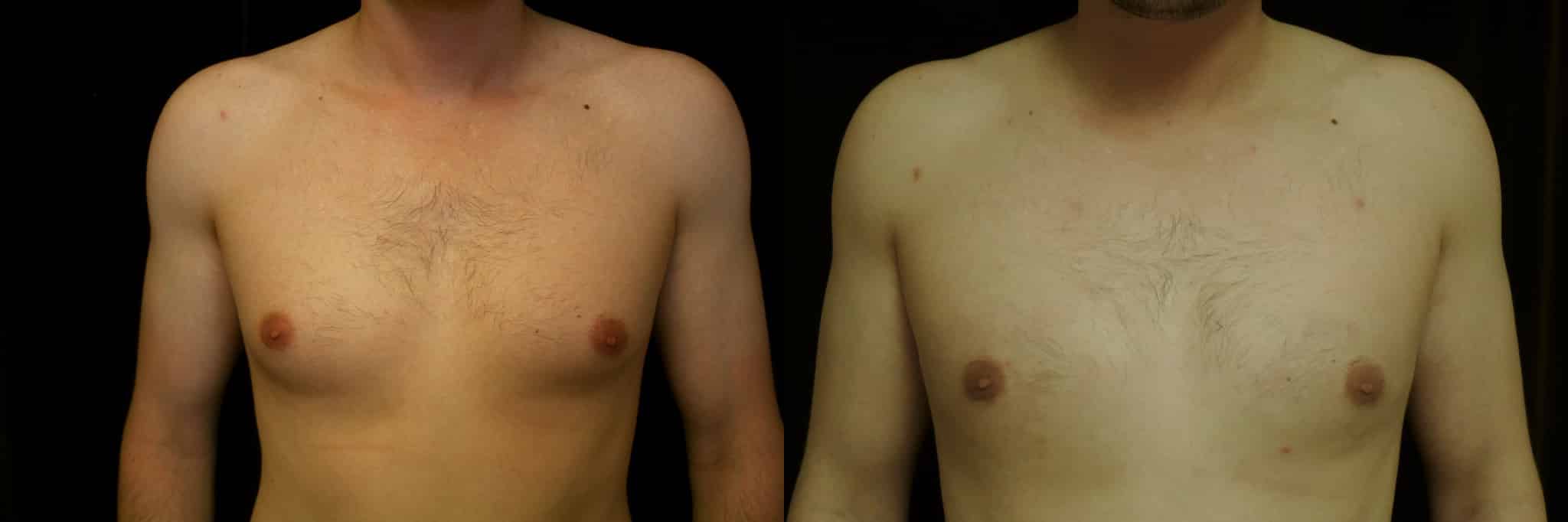 Gynecomastia Patient 14 Before & After