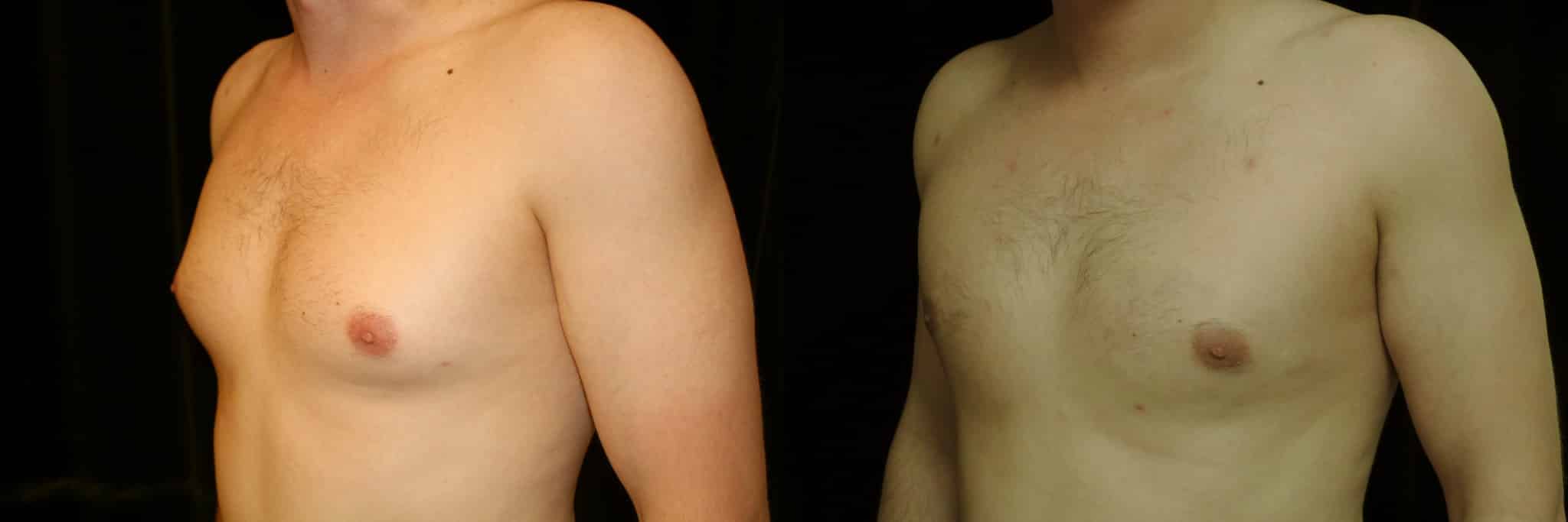 Gynecomastia Patient 14 Before & After Details