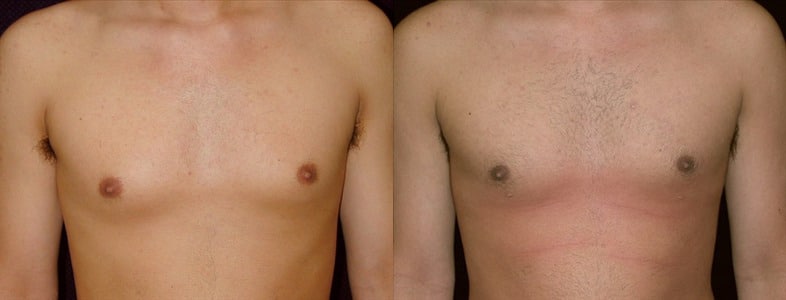 Gynecomastia Patient 11 Before & After