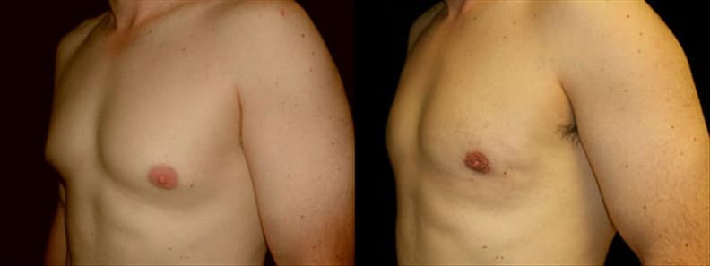 Gynecomastia Patient 18 Before & After Details