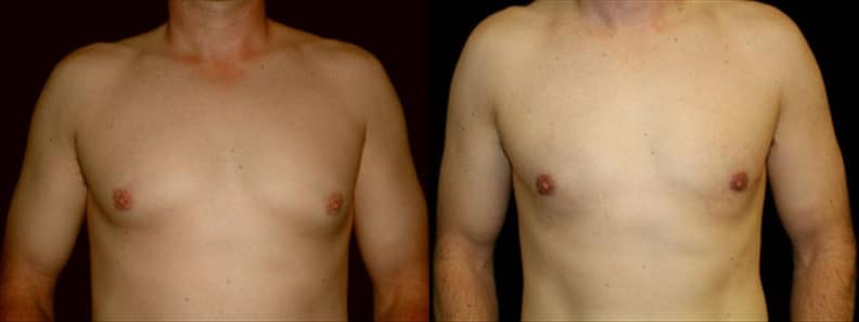 Gynecomastia Patient 18 Before & After