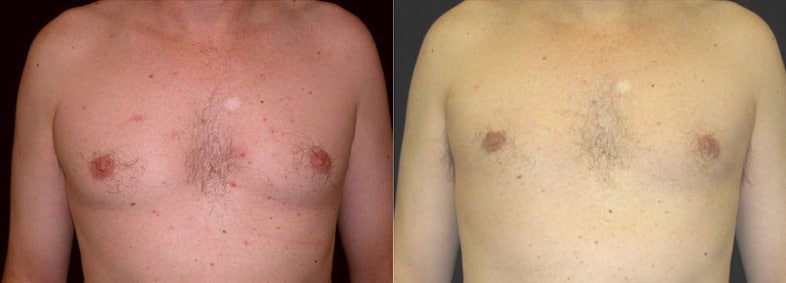 Gynecomastia Patient 10 Before & After