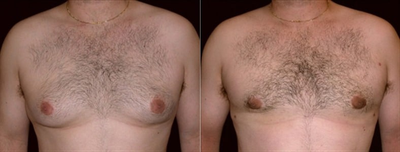 Gynecomastia Patient 8 Before & After