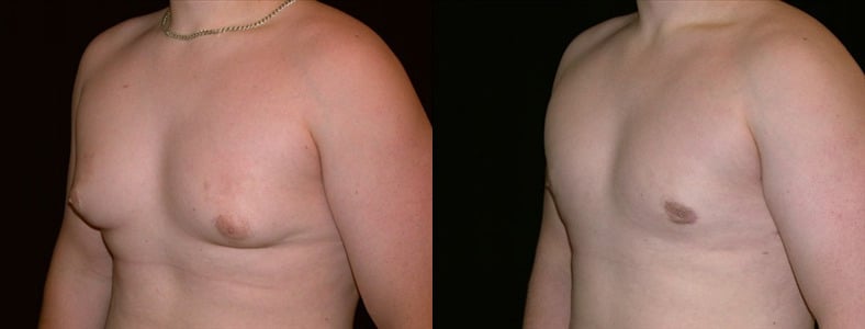 Gynecomastia Patient 1 Before & After