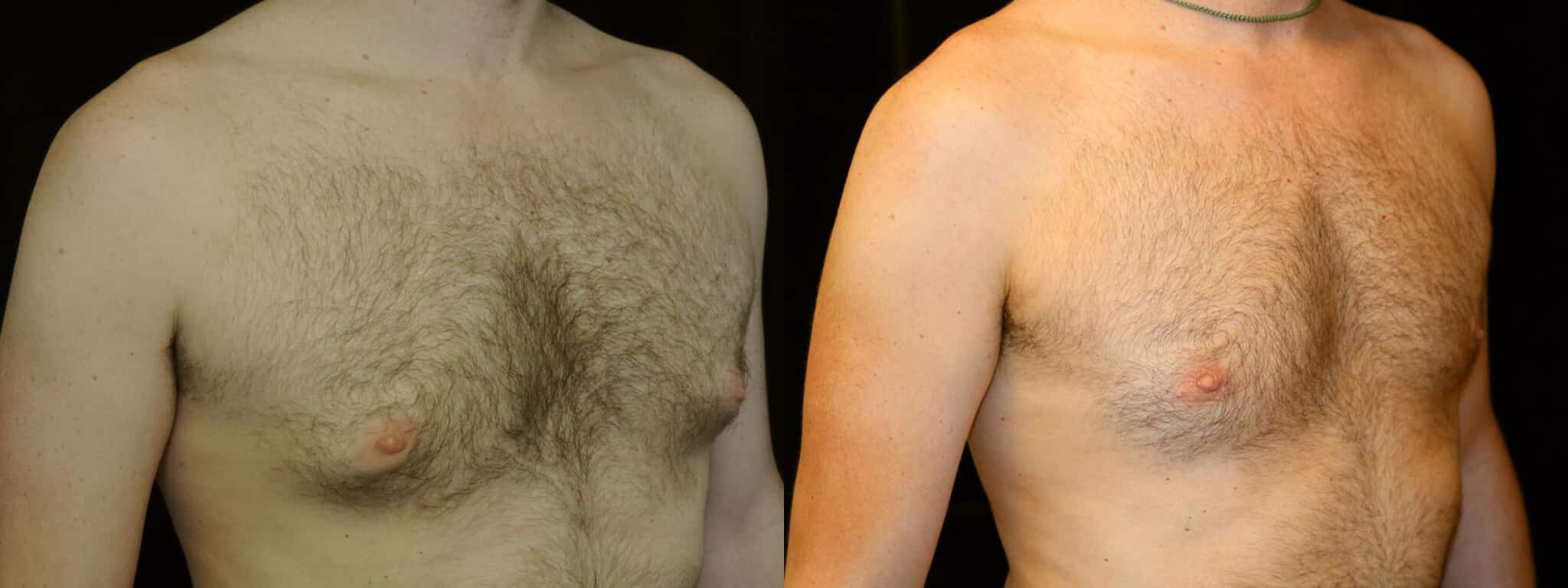 Gynecomastia Patient 17 Before & After Details