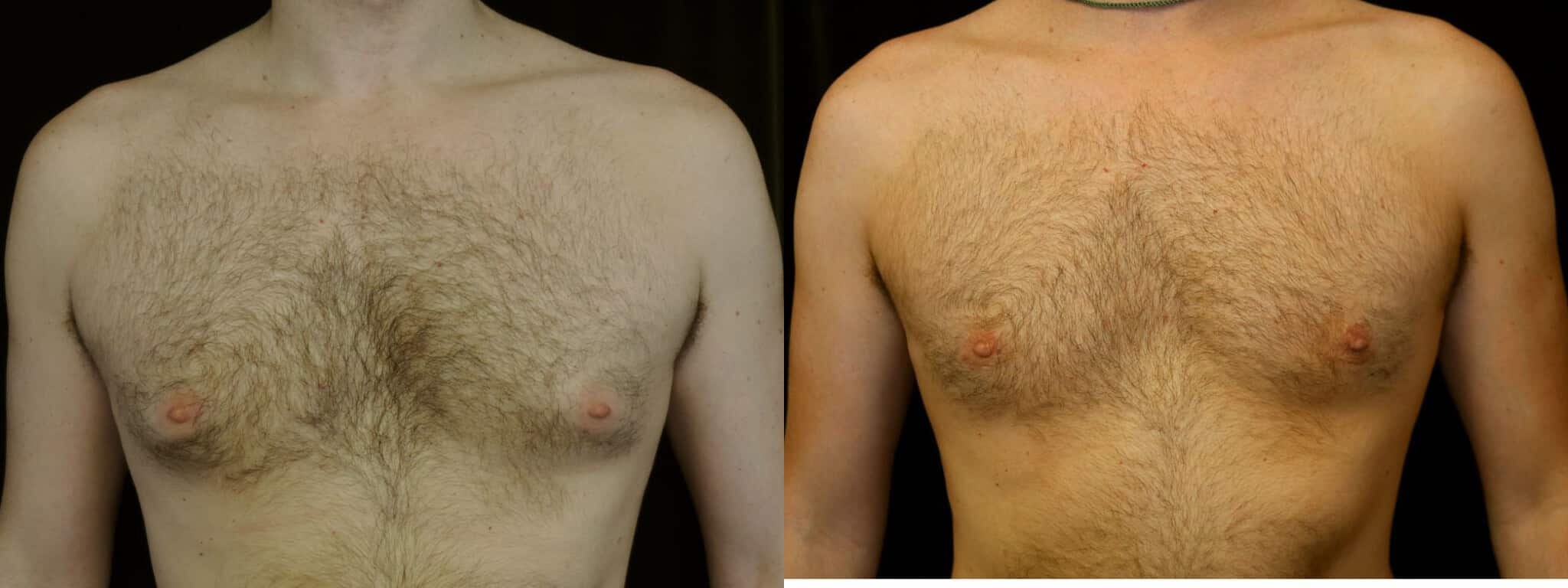 Gynecomastia Patient 17 Before & After