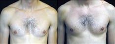 Gynecomastia Patient 18 Before & After