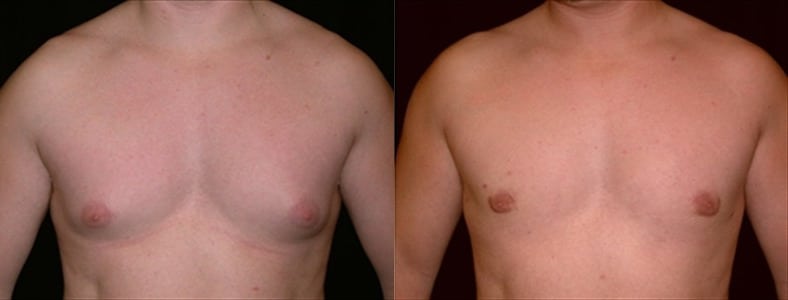 Gynecomastia Patient 12 Before & After