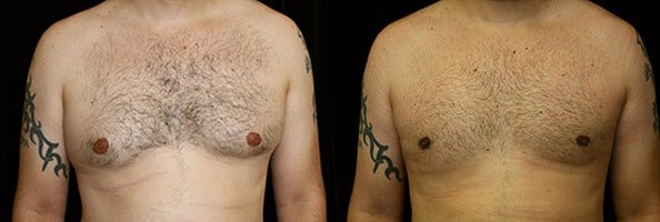 Gynecomastia Patient 17 Before & After