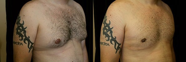 Gynecomastia Patient 17 Before & After Details