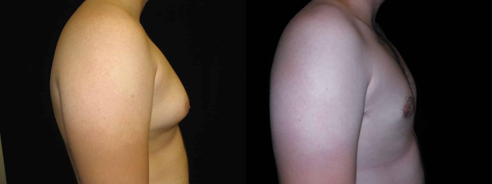 Gynecomastia Patient 16 Before & After Details