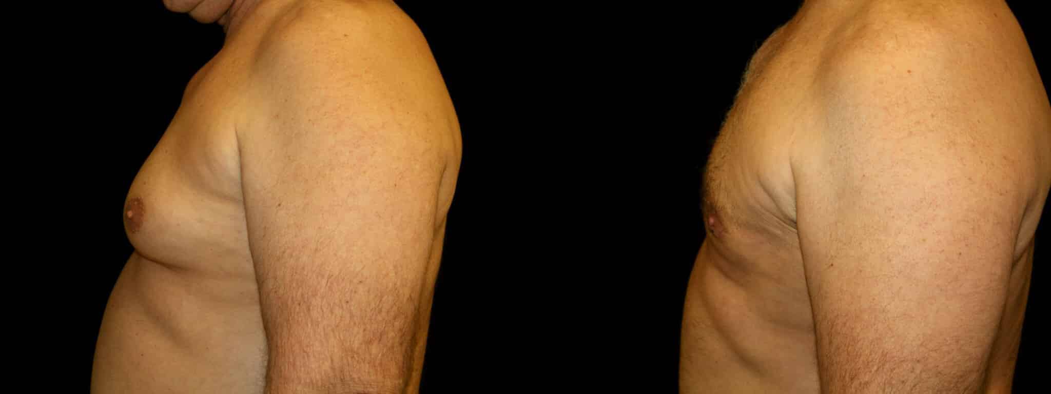 Gynecomastia Patient 1 Before & After Details