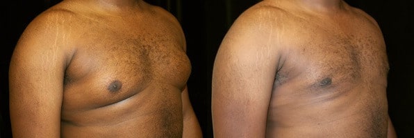 Gynecomastia Patient 19 Before & After Details