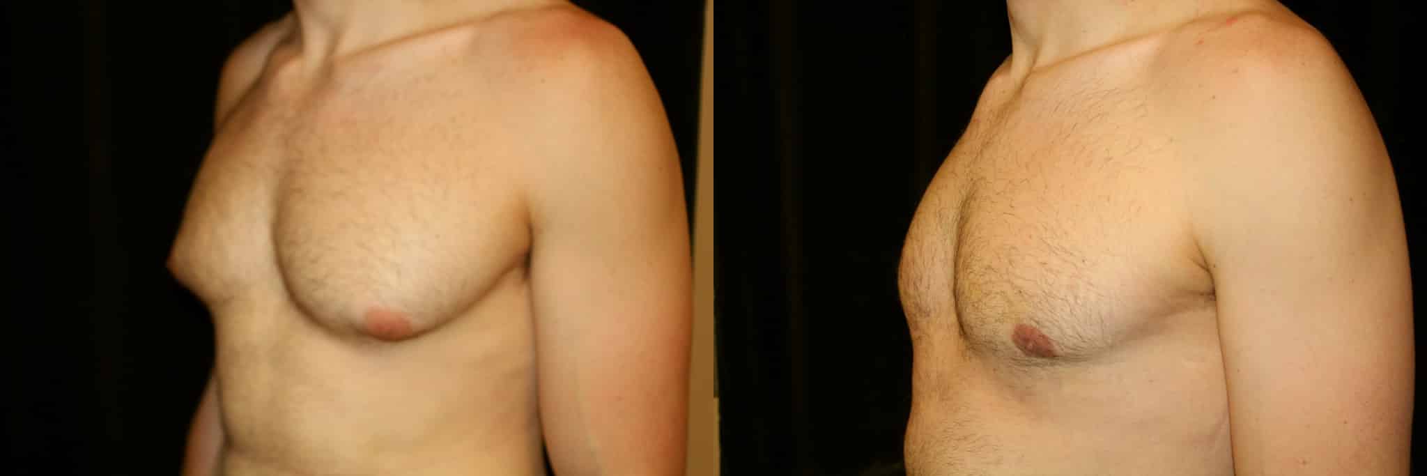 Gynecomastia Patient 10 Before & After Details