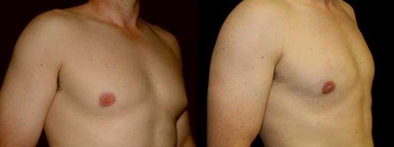 Gynecomastia Patient 18 Before & After Details