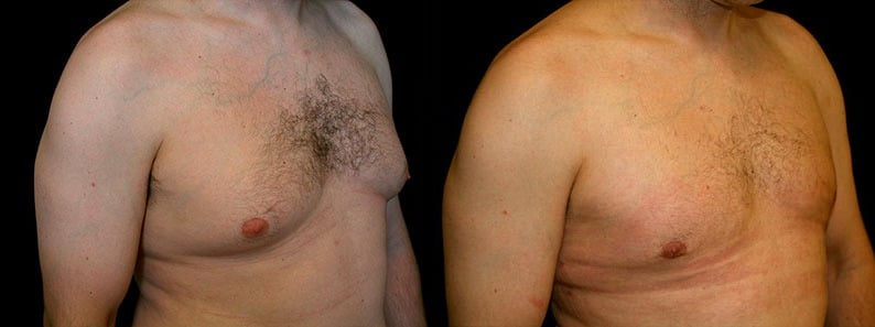 Gynecomastia Patient 15 Before & After Details