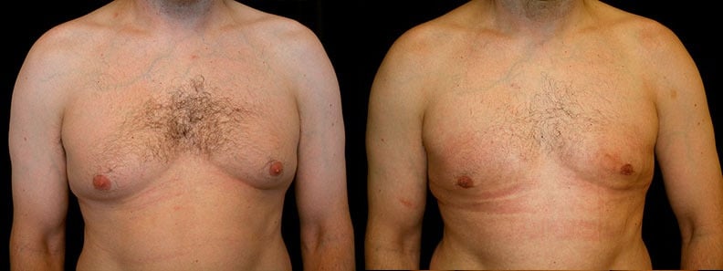 Gynecomastia Patient 15 Before & After