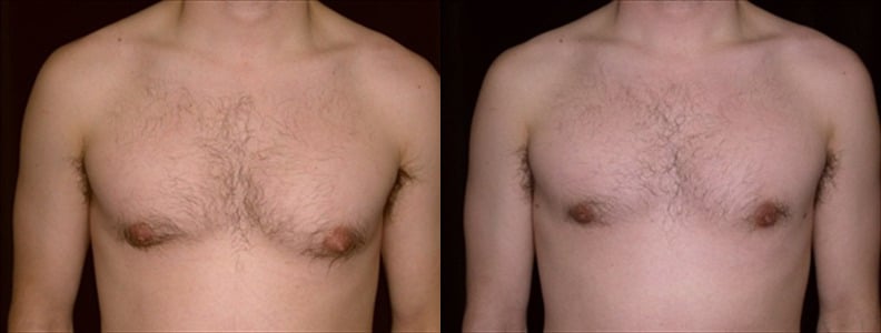 Gynecomastia Patient 16 Before & After