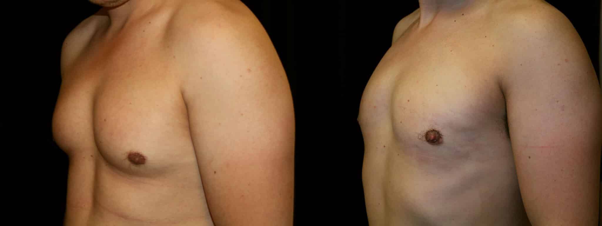 Gynecomastia Patient 1 Before & After Details