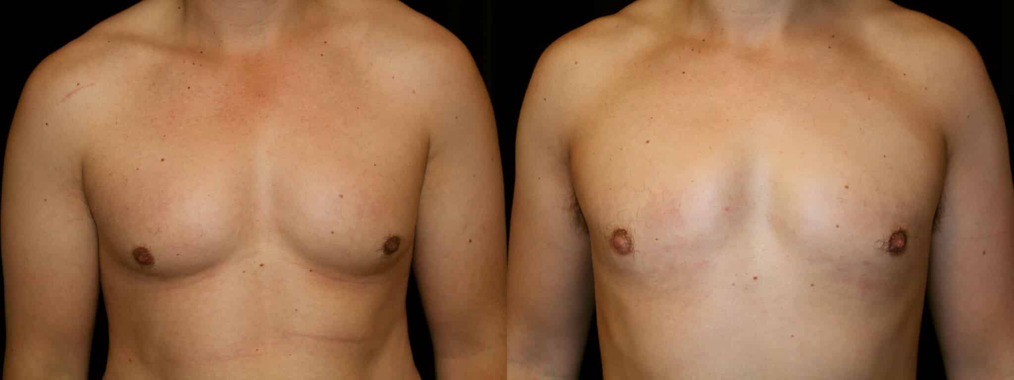 Gynecomastia Patient 1 Before & After