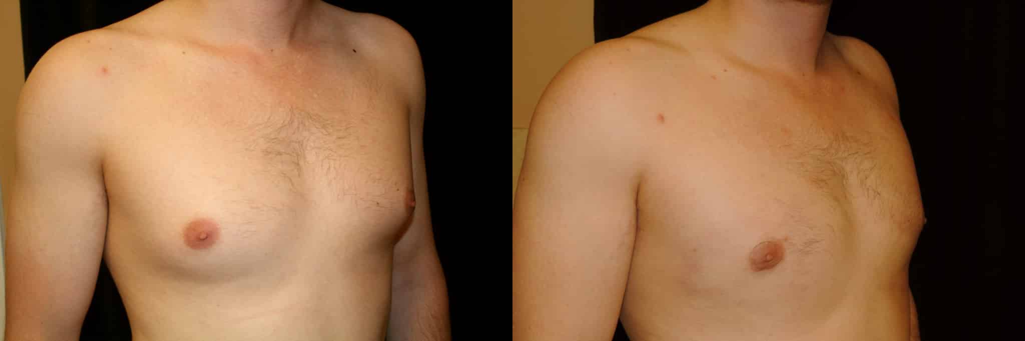 Gynecomastia Patient 14 Before & After Details