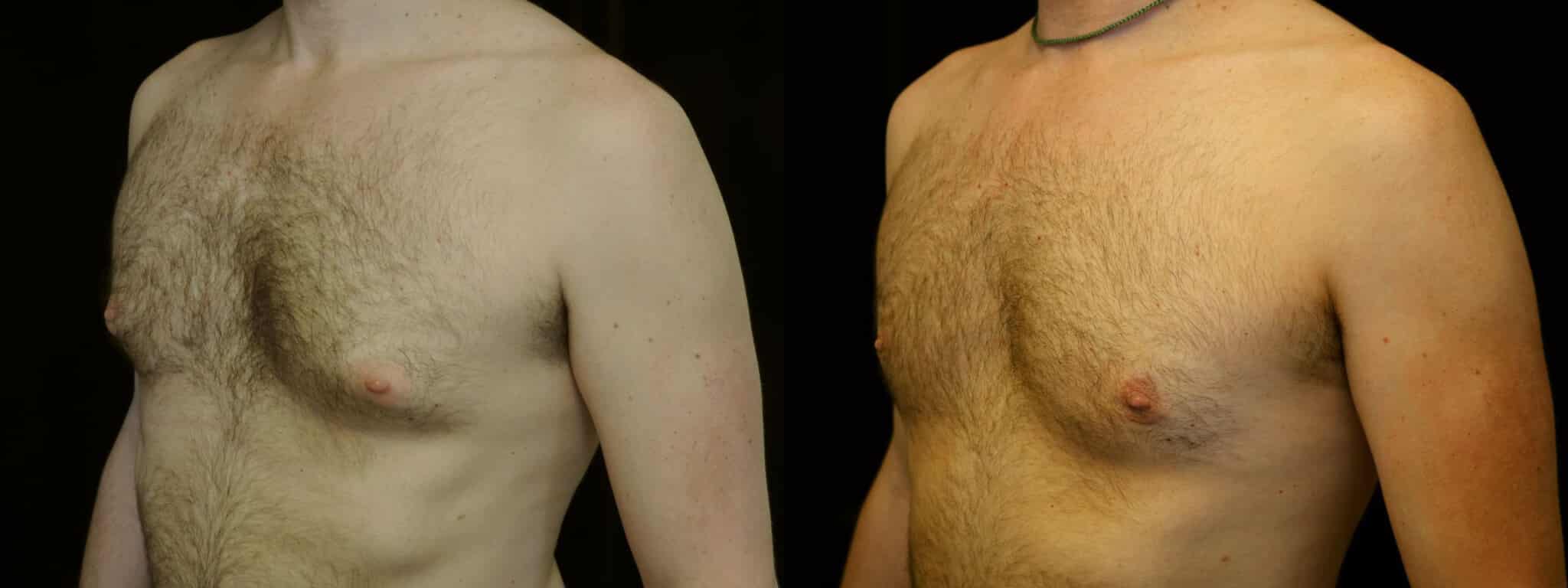 Gynecomastia Patient 17 Before & After Details