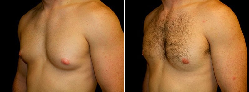 Gynecomastia Patient 13 Before & After Details