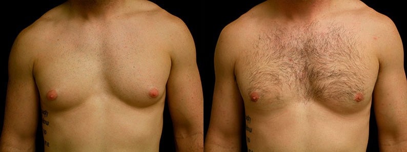 Gynecomastia Patient 13 Before & After