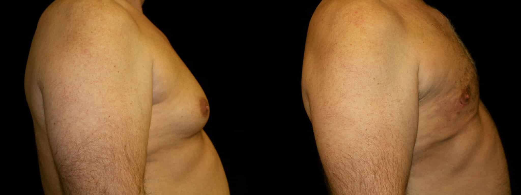 Gynecomastia Patient 1 Before & After Details