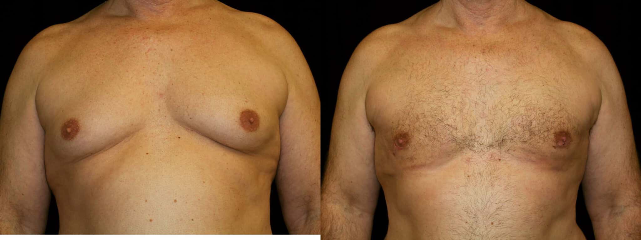 Gynecomastia Patient 1 Before & After