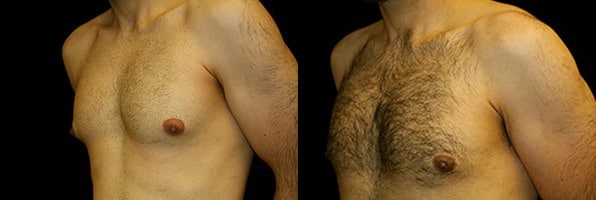 Gynecomastia Patient 1 Before & After Details