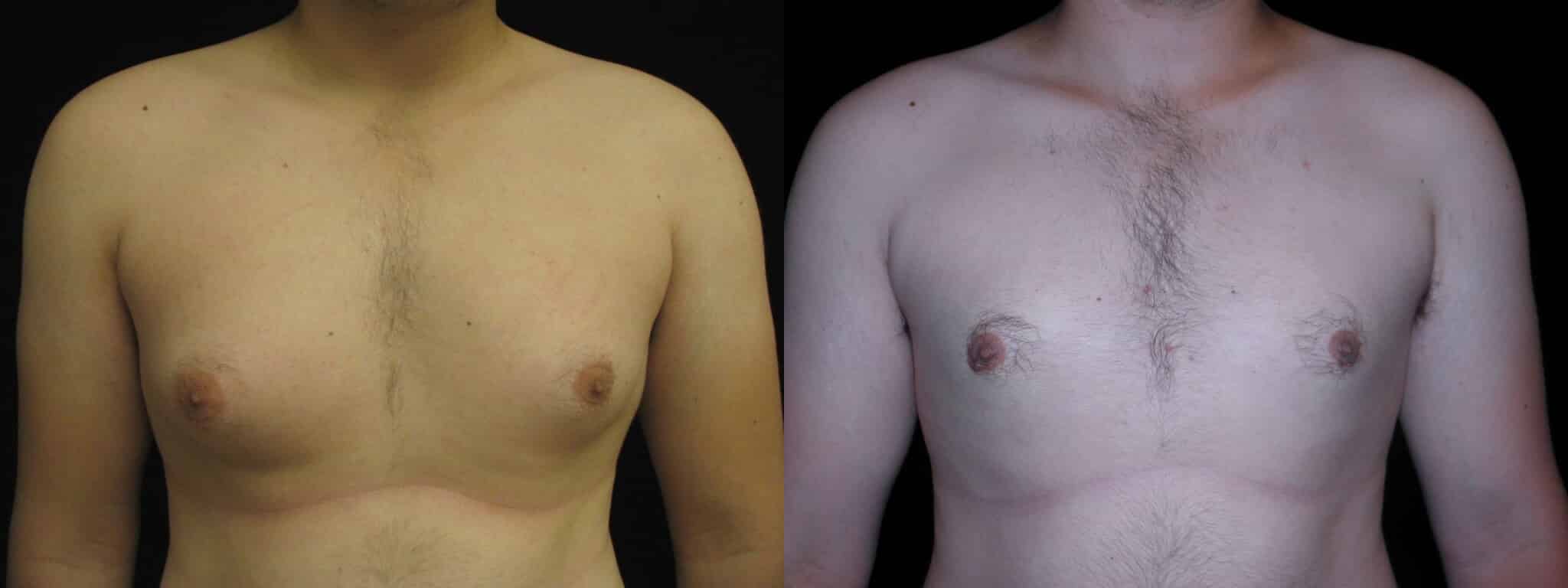 Gynecomastia Patient 16 Before & After