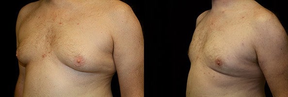 Gynecomastia Patient 15 Before & After Details