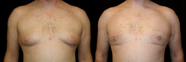 Gynecomastia Patient 15 Before & After