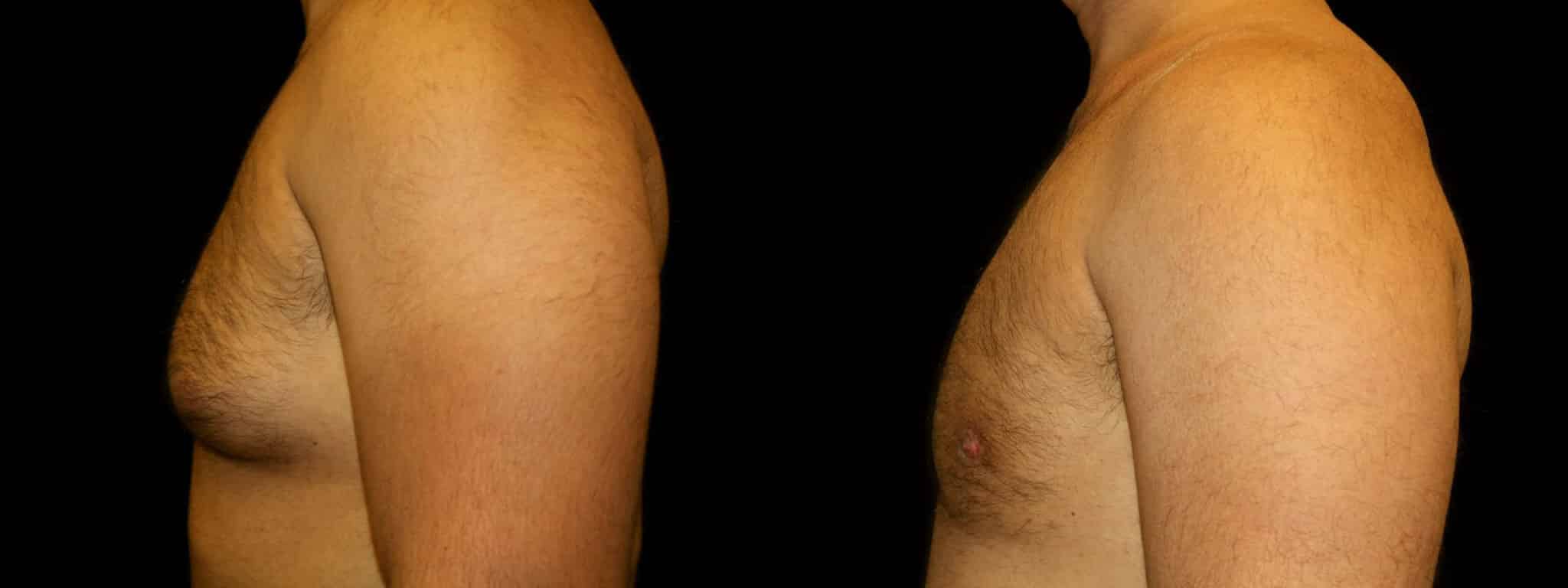 Gynecomastia Patient 11 Before & After Details